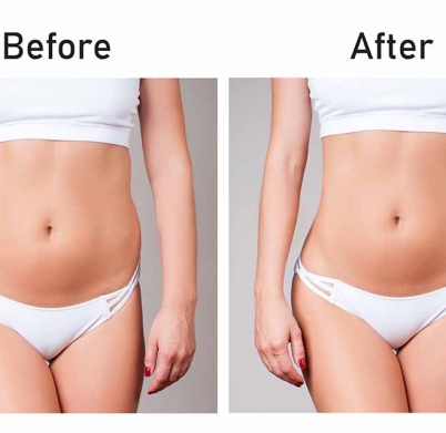 Liposuction-{-Female-Oriented-}